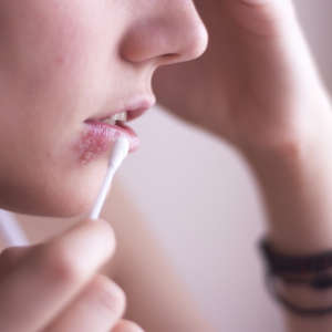 فيروس HSV-1 أكثر ما يُعرف بالقروح الباردة التي يُحدثها حول الفم.