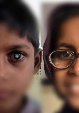 Anonymised photographs of two adolescent congenital cataract patients from Uttar Pradesh, India, before (left) and after (right) surgery. Surgery involves the placement of an artificial lens in the eye that restores sight.
