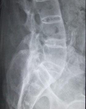 
Lateral lumbar spine X-ray demonstrating ankylosing spondylitis.
